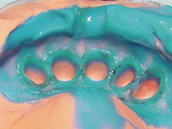 <strong>Algiloid®</strong><br>Hydro-Abformmaterial