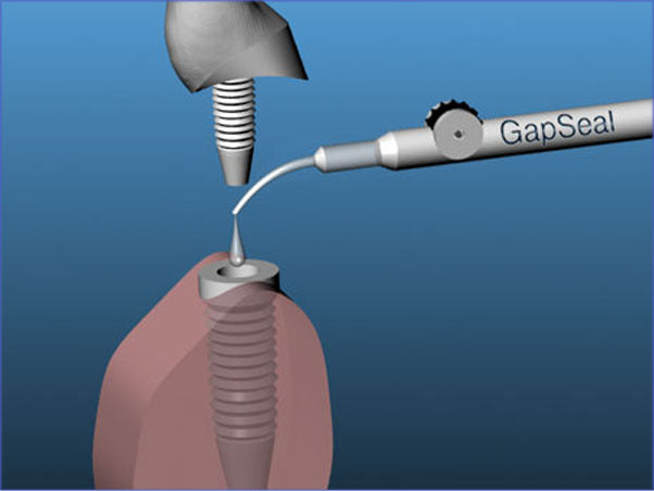 <strong>Hager & Werken GapSeal®</strong><br>Implantat-Versiegelung