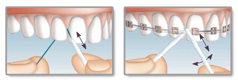 <strong>Miradent Mirafloss® Implant</strong><br>Zahnseide für Implantate / Flossfäden vom Band