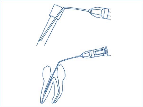 <strong>Hager & Werken Miraject® Endo Luer</strong><br>Stumpfe und biegsame Kanüle für die Endodontie