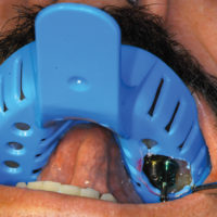 <strong>Hager & Werken Miratray® Implant</strong><br>Implantatabformlöffel