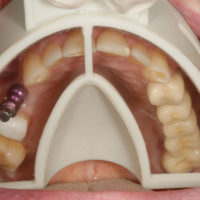 <strong>Hager & Werken Miratray® Implant</strong><br>Implantatabformlöffel