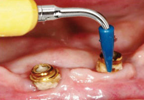 Die Cavitron® SofTip Einwegtips wurden speziell für die professionelle Reinigung von Titanimplantaten und Implantat-Abutments entwickelt.